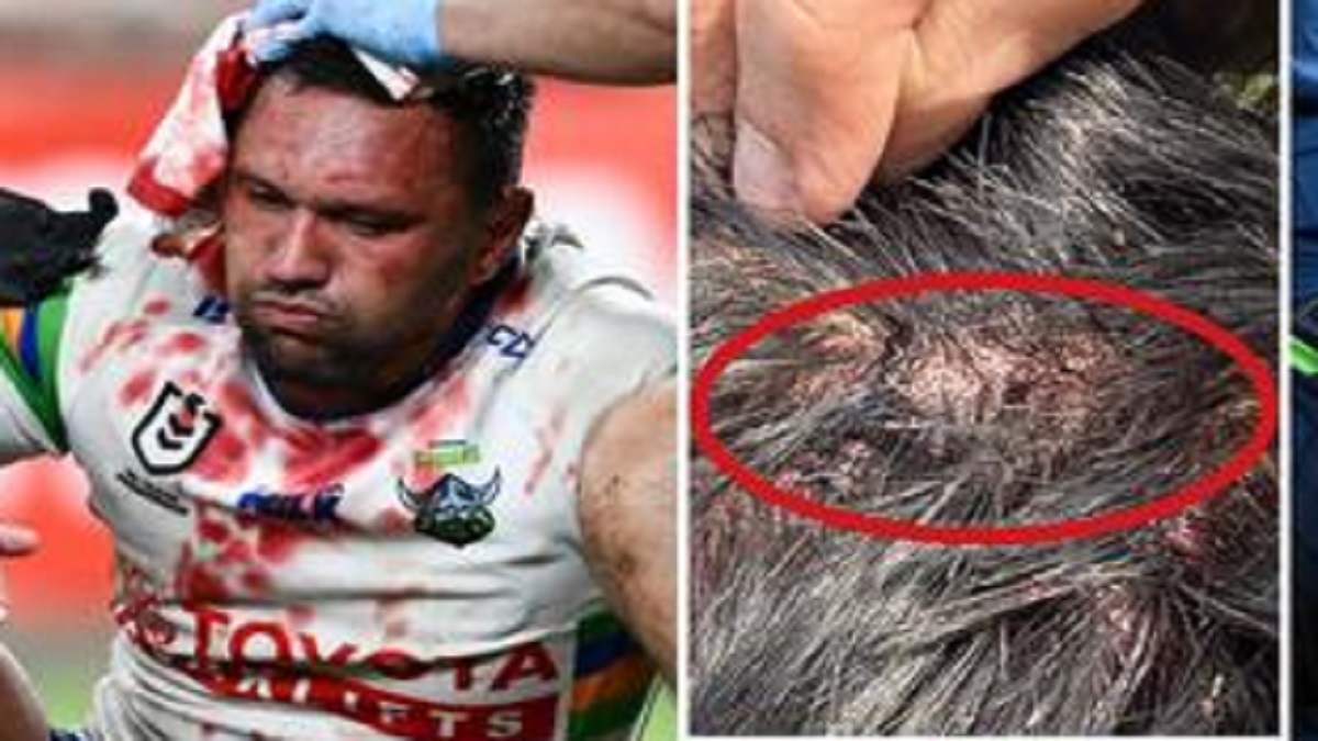LOOK: Video of Jordan Rapana's head injury shows a gash on his head after hitting his knee to the head