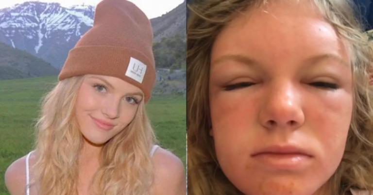 Woman skips sunscreen on a beach outing and watches her face swell like a balloon