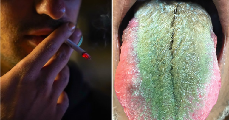 An Ohio man’s tongue turns green and hairy after years of smoking cigarettes and taking antibiotics