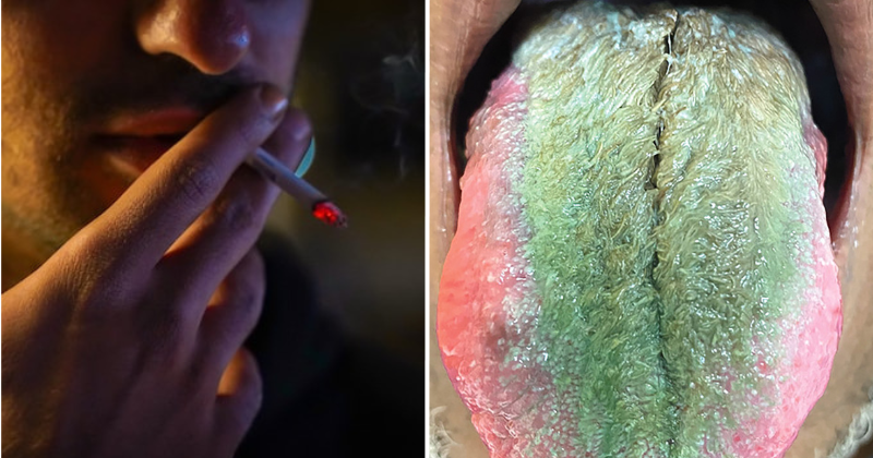 An Ohio man's tongue turns green and hairy after years of smoking cigarettes and taking antibiotics