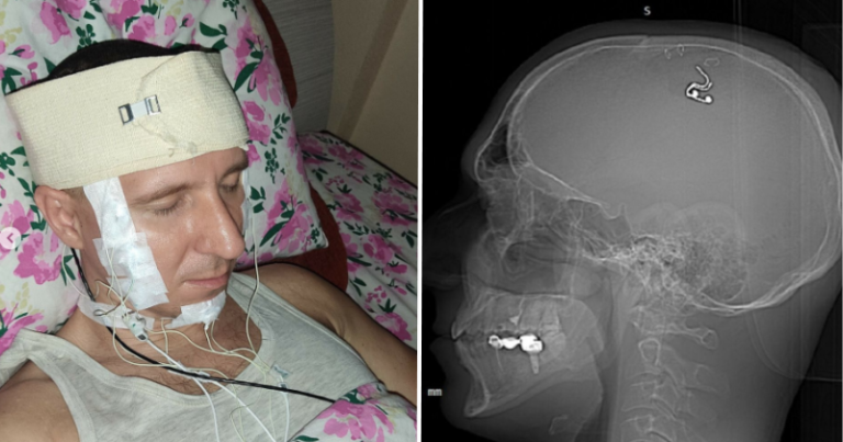 Mind-blowing attempt: Russian man drills holes in his skull to insert a ‘dream control’ chip into his brain