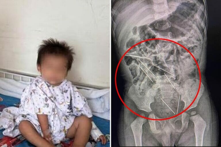 A 2-year-old boy accidentally swallows 8 needles: “I was focused on my work”