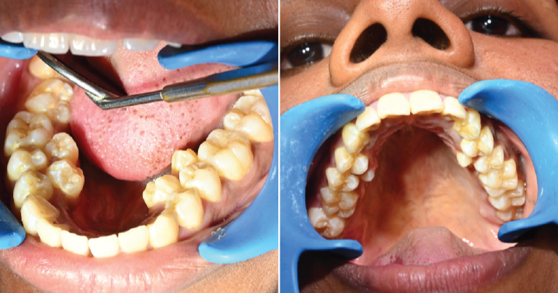 Smile wide!  Indian woman with 38 teeth creates Guinness world record