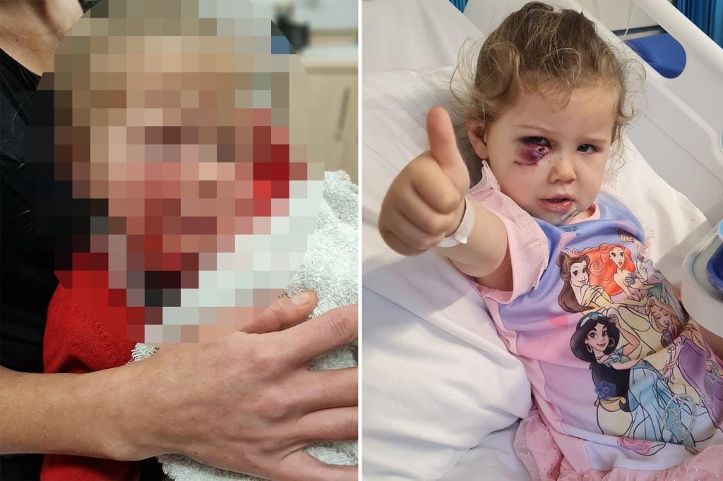 3-year-old girl mauled by dog ​​while playing, leading to hours-long facial surgery