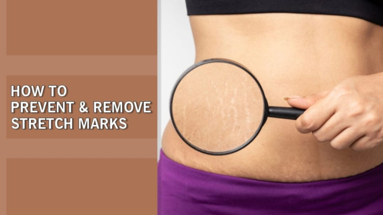 How To Prevent and Remove Stretch Marks On The Body? [10 Effective Tips]